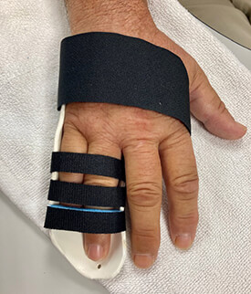 A hand affected by Dupuytrens contracture.