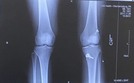 X-ray showing the location of the pin placed in Jeena’s left knee during surgery.